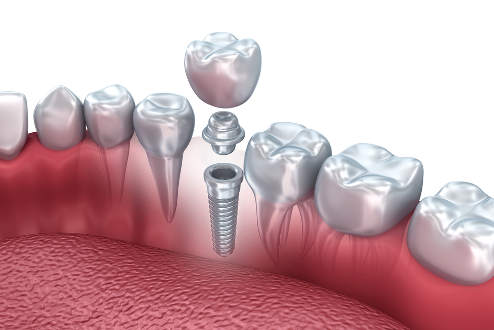 Implants in Litchfield, MI 1 1784762235 445eb4b3283f4de18285a350f3def9b5 1 1