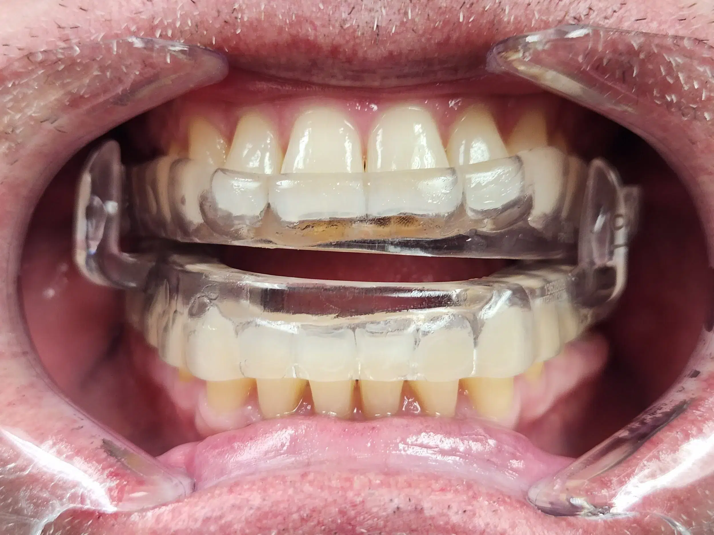 Sleep Dentistry in Litchfield, MI 2 1784762350 20251019 141326 1 1